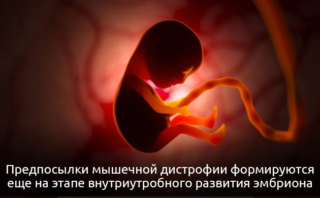Мышечная дистрофия Формирование мышечной дистрофии на этапе развития эмбриона