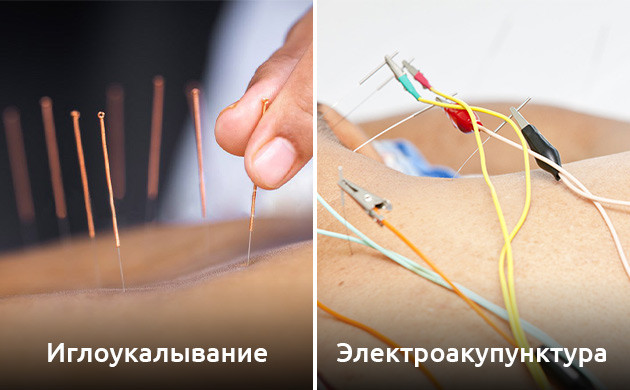 Альтернативные методы облегчения отмены опиоидов Иглоукалывание при опиоидной зависимости