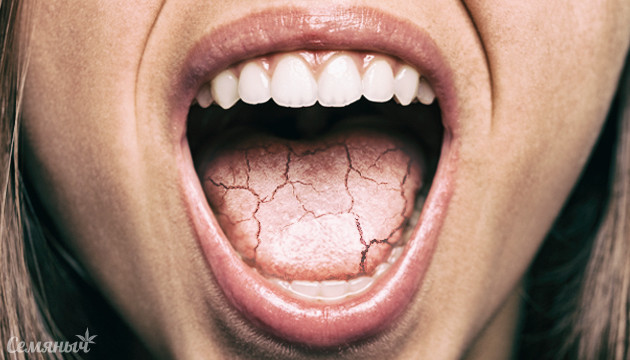Способы избавить от сухости во рту Сухость во рту